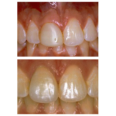 Porcelain Crowns (Caps)