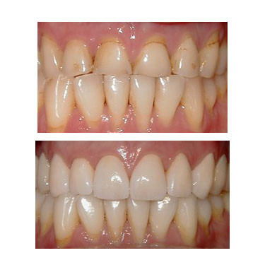 Porcelain Crowns (Caps)