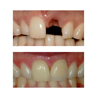 Porcelain Crowns (Caps)