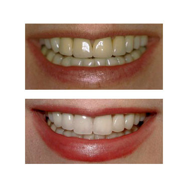 Porcelain Crowns (Caps)