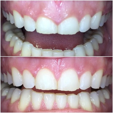 Crown Lengthening