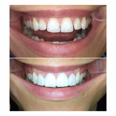 Veneers